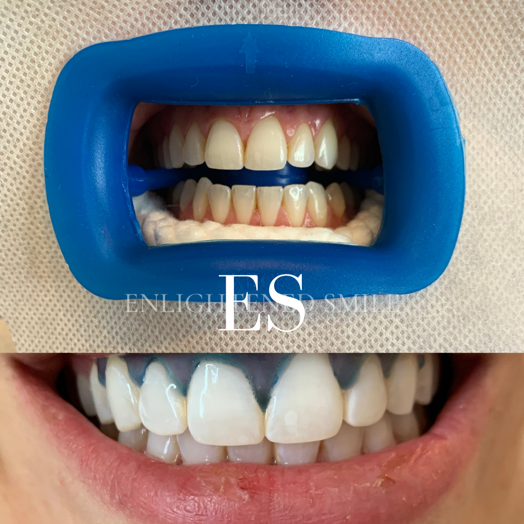 Gingiva Shield Prevest Denpro - Résine De Protection Gingivale à Polymérisation Lumineuse